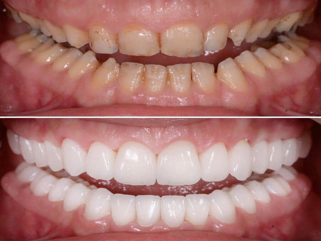 Full Mouth Rehabilitation Dentist In Indirapuram Ghaziabad Full Mouth Rehabilitation Dentist In Indirapuram Ghaziabad